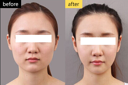 注射瘦臉針瘦臉價(jià)格詳解，全面了解瘦臉針費(fèi)用及注意事項(xiàng)