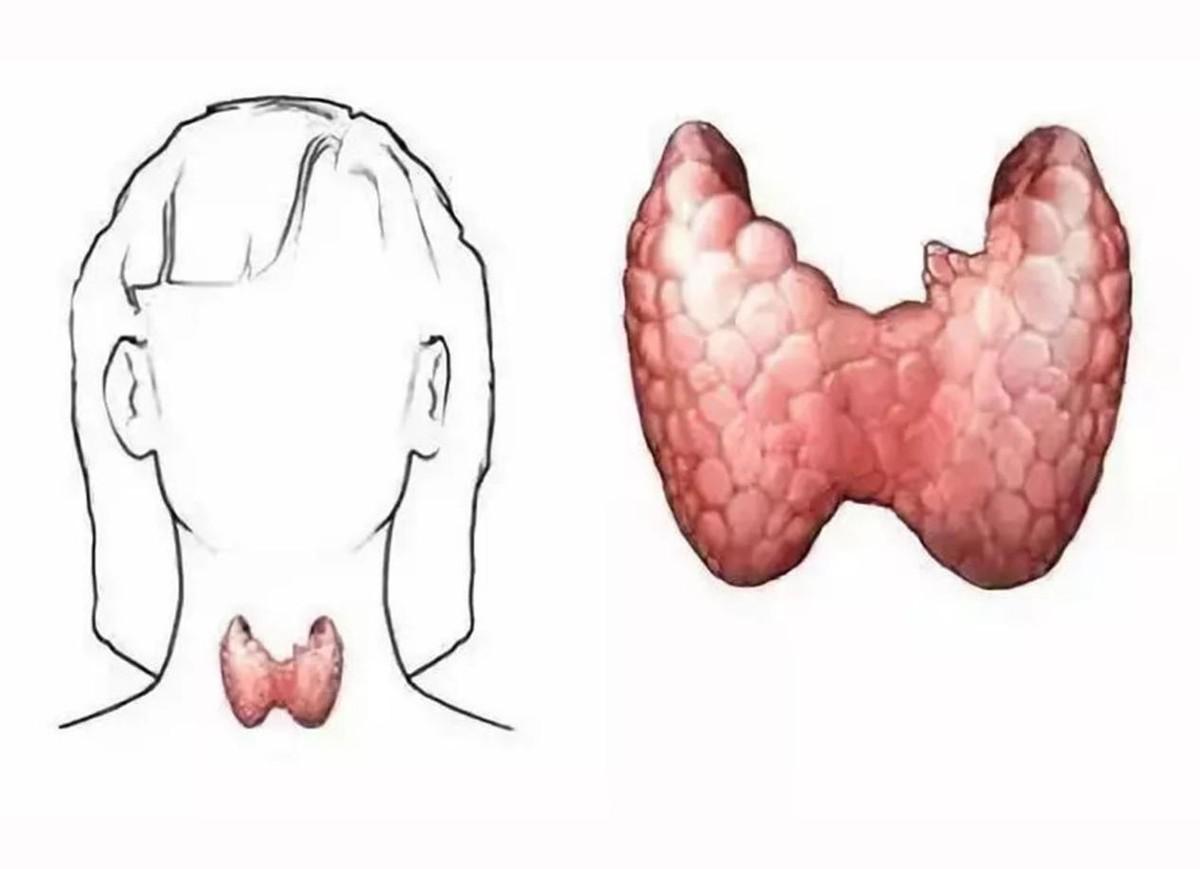 最新甲狀腺檢查步驟指南，詳細步驟解析