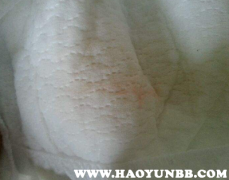 最新肺炎淤青的成因、表現(xiàn)與防治策略解析