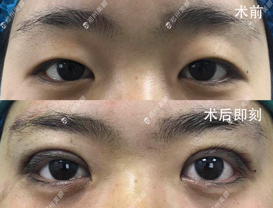 最新雙眼皮手術(shù)技巧，創(chuàng)新割雙眼皮方法解析